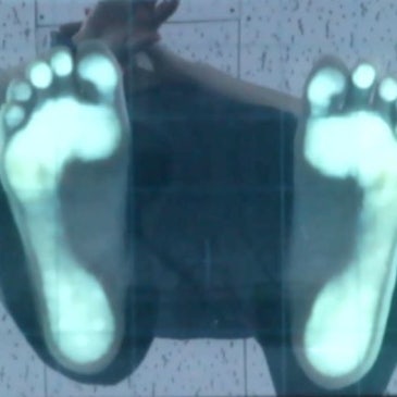걸으면 심해지는 뒤꿈치 통증, 30대 여성 맞춤 깔창 사례