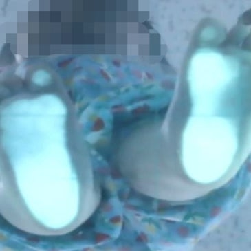4세 아이 까치발, 기존 맞춤 깔창을 확인하고 다시 제작한 사례