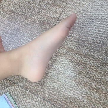 유연성 평발 검사 중 확인된 안짱 걸음, 7세 아이 맞춤 깔창 제작 사례