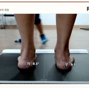 서 있을 때 무너지는 유연성 평발, 러닝용 맞춤 깔창 제작 사례