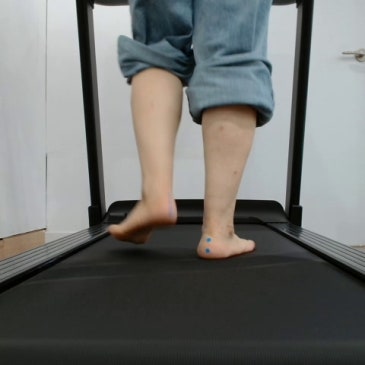 팔자걸음 맞춤깔창, 발 모양보다 실제 보행을 확인해야 하는 이유