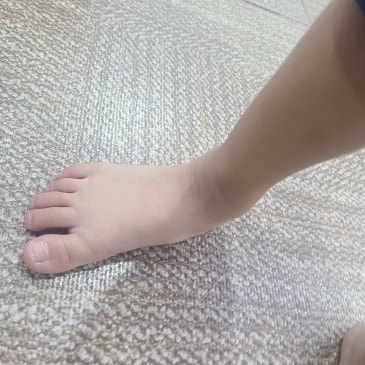 5세 아이 평발 교정, 발바닥 전체가 닿는 평발 맞춤 깔창 제작 사례