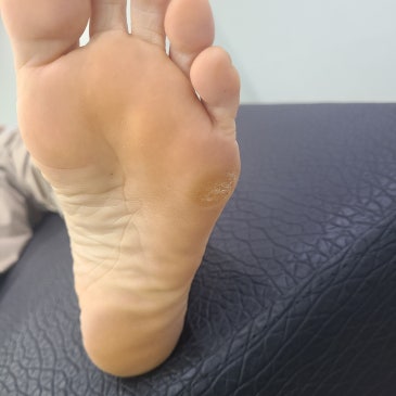 요족 맞춤 깔창, 더 아픈 오른발과 덜 아픈 왼발은 무엇이 달랐을까?