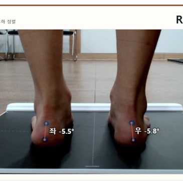 걸을 때 왼발을 끄는 원인, 평발 때문일까? 맞춤 깔창 제작 사례