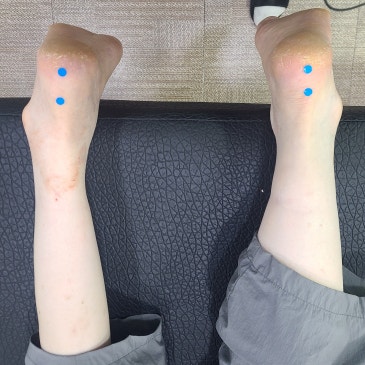 소아마비 맞춤 깔창, 다리 길이 차이와 좌우 다른 보행을 고려한 제작 사례