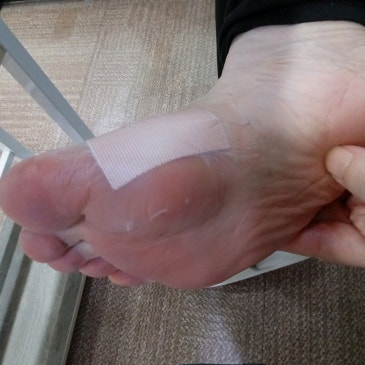 종자골염 맞춤 깔창, 엄지 아래 한 곳이 아픈 요족 고객 제작 사례