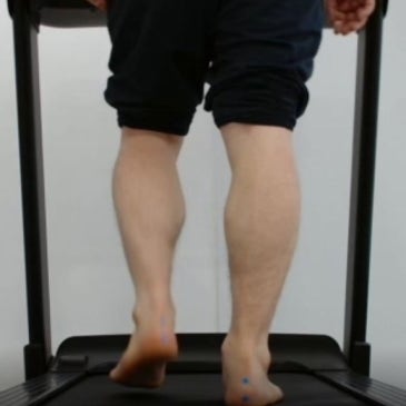 아킬레스건염 맞춤 깔창, 아치가 높다고 모두 요족일까요?