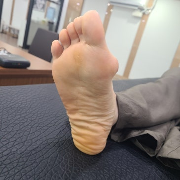 무지외반증 맞춤 깔창, 발목의 뻣뻣함과 앞발 굳은살을 확인한 제작 사례