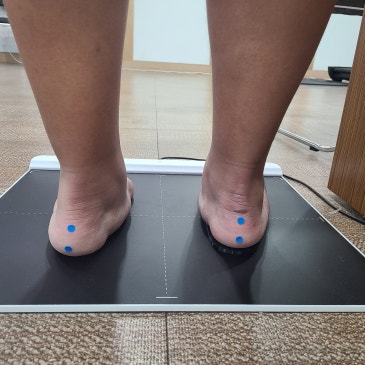 청소년 평발교정 깔창, 평발만 보고 만들면 안 되는 이유