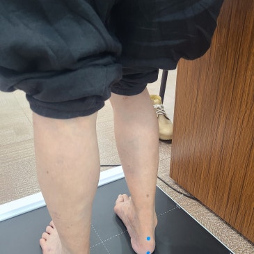 인공관절 수술 후 5CM 다리 길이 차이, 90대 고객 맞춤 깔창 제작 사례
