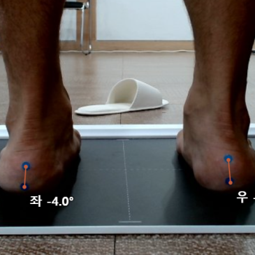 구두 뒤꿈치 통증, 한쪽 발만 아픈 이유를 확인한 맞춤 인솔 사례