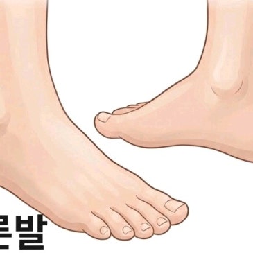 아킬레스건염 깔창, 3km 달리면 오른쪽 아킬레스건과 무릎이 불편했던 사례