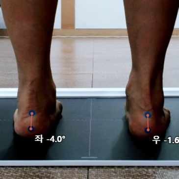 발바닥 통증 깔창, 오래 걸을수록 아팠던 발의 회내와 팔자걸음