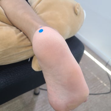 발바닥 앞쪽 통증, 원인이 아킬레스건에 있을 수도 있다고? 맞춤 깔창 제작 사례